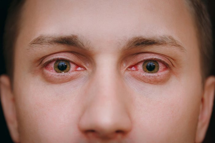 Bloodshot eyes that could be caused by marijuana use