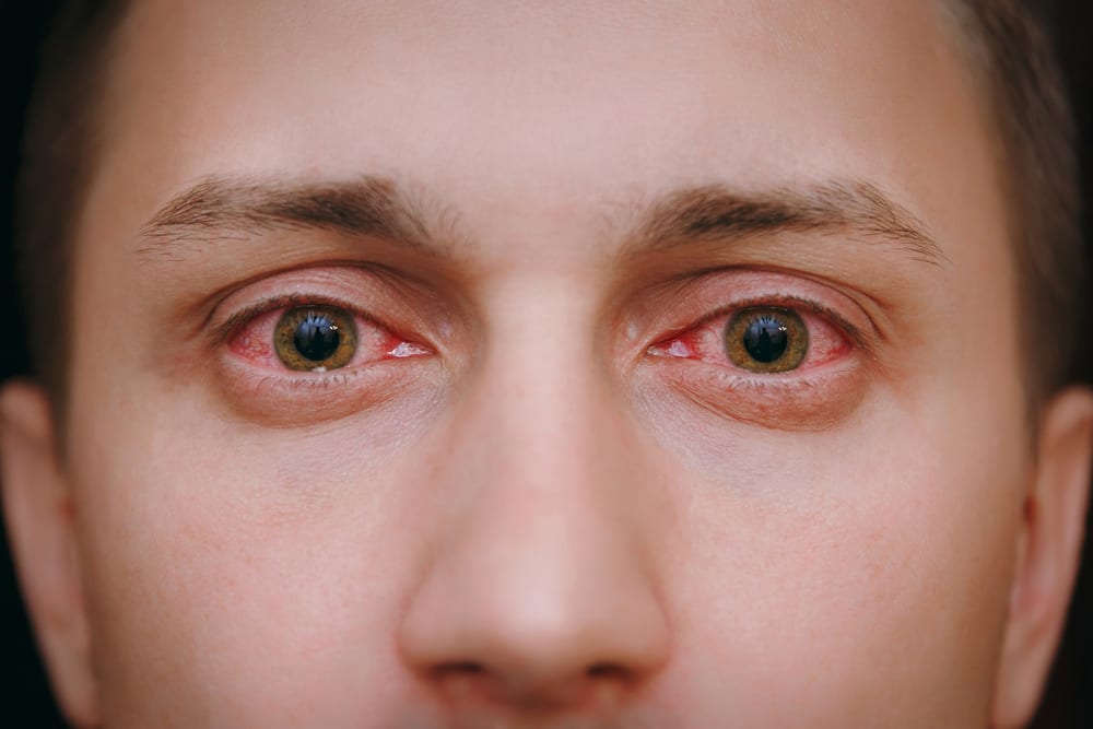 5 Tricks to Avoid Getting Red Eyes from Weed | Leafbuyer