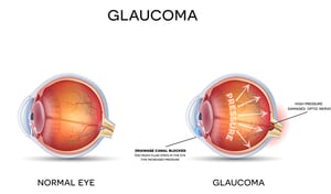 drawing showing a normal eye vs an eye with glaucoma