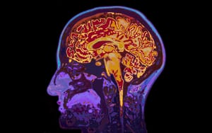 image of an MRI scan of a brain from the side